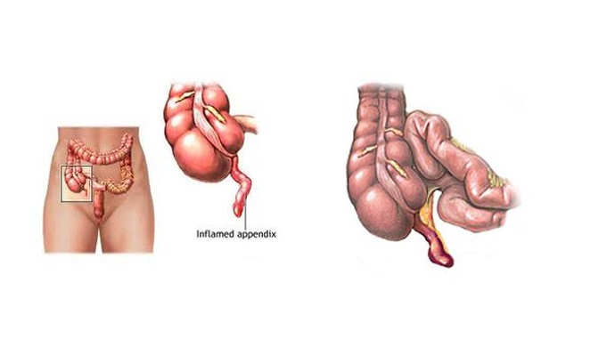 Appendicitis Treatment in Mahoba