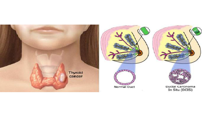 Breast And Thyroid Gland Tumors Treatment in Moradabad