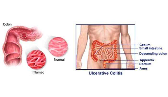 Colitis Treatment in Mainpuri
