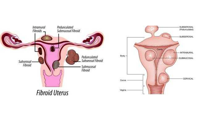 Fibroids Uterus Treatment in Kushinagar