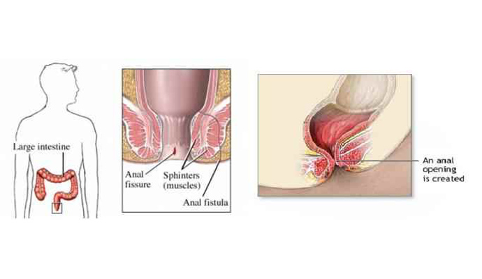 Anal treatment