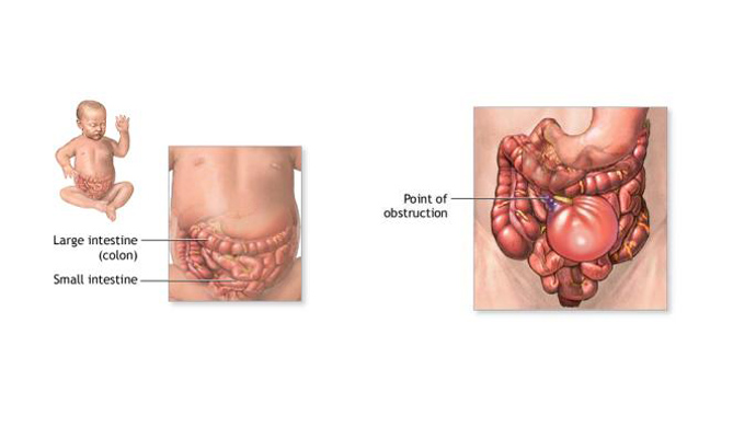 Intestinal Obstruction Treatment in Gonda