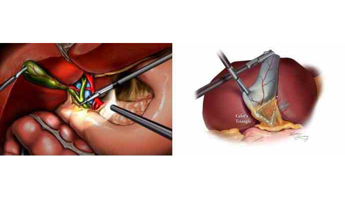 Laparoscopic cholecystectomy Treatment in Hamirpur