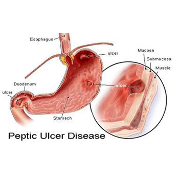 Peptic Ulcer Treatment in Maharajganj