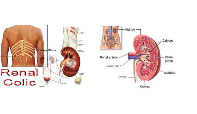 Renal Colic Treatment in Mathura