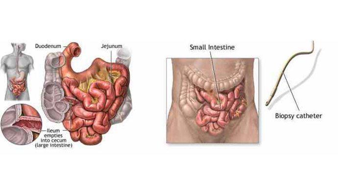 Small Bowel Perforations Treatment in Kanpur