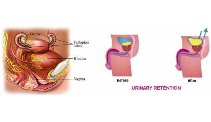 Urinary Retention Treatment in Gonda