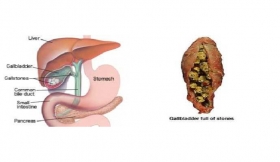 Gallbladder Stones Treatment in Mainpuri