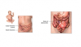 Intestinal Obstruction Treatment in Mau