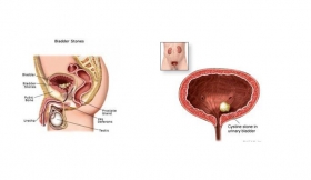 Urinary Bladder Stones Treatment in Meerut