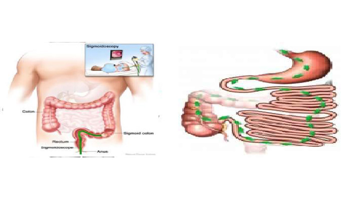 Amoebic Colitis Treatment in Polytechnic