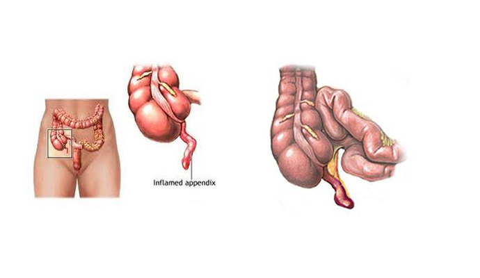 Appendicitis Treatment in Sambhal