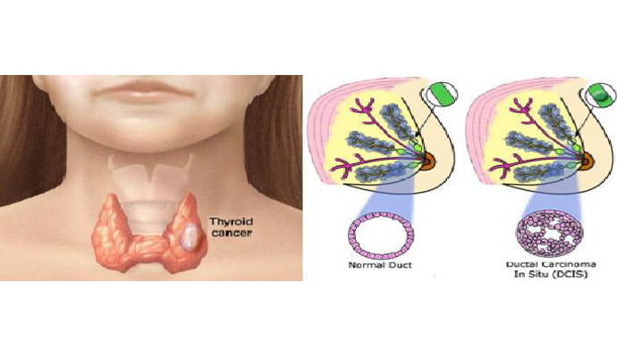 Breast And Thyroid Gland Tumors Treatment in Ogipur