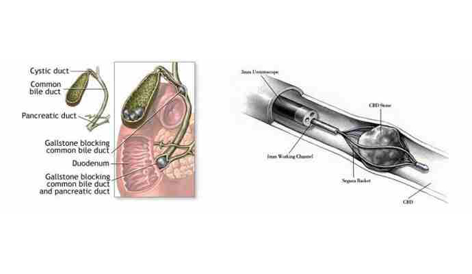 CBD Stones Treatment in Klyanpur