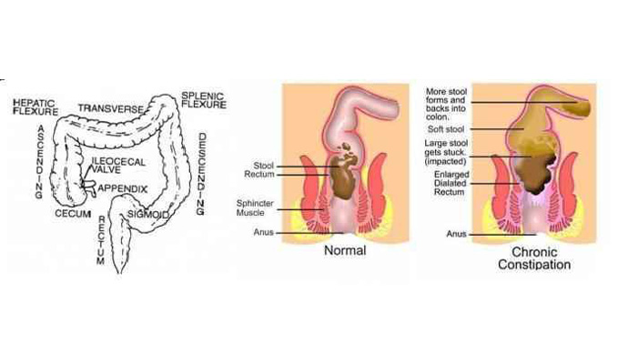 Constipation Treatment in Mahoba