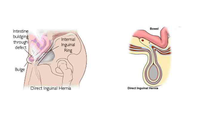 Direct Inguinal Hernia Surgery