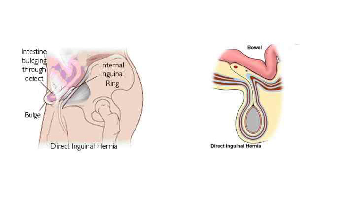 Direct Inguinal Hernia Surgery Treatment in Harautha