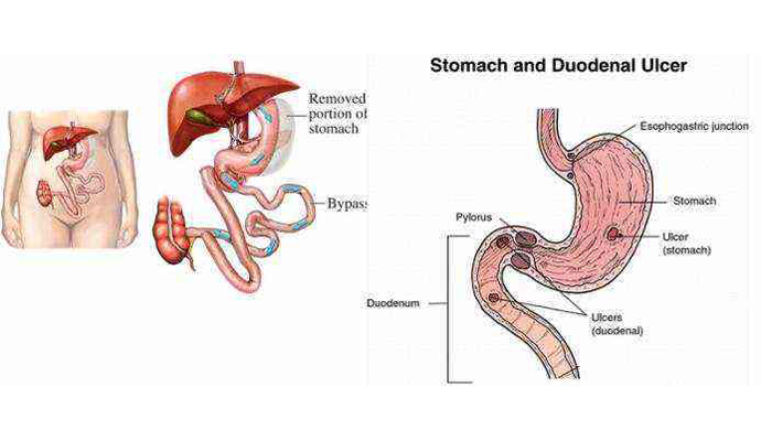 Duodenal Perforation Treatment in Etawah