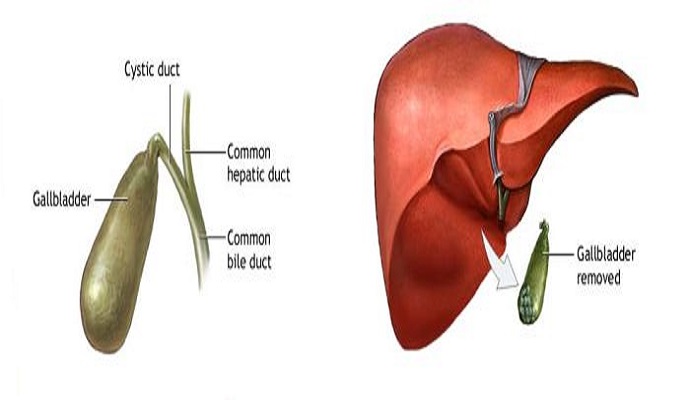 Gallbladder Diseases