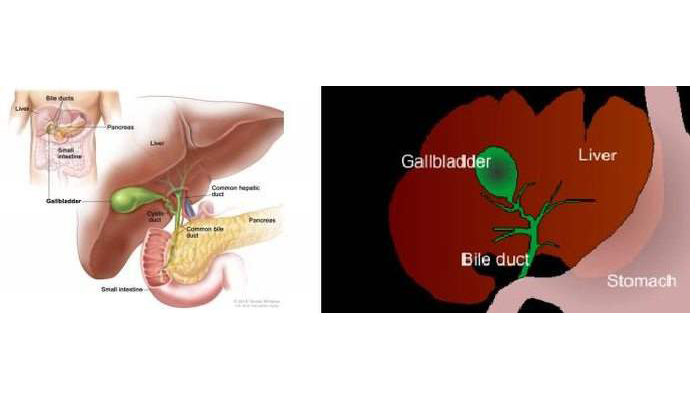 Gallbladder Mucocoel Treatment in Kazimabad