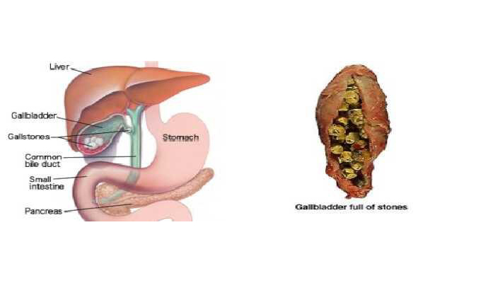 Gallbladder Stones Treatment in Banda