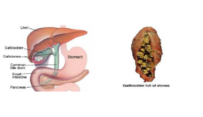 Gallbladder Stones Treatment in Pratapgarh