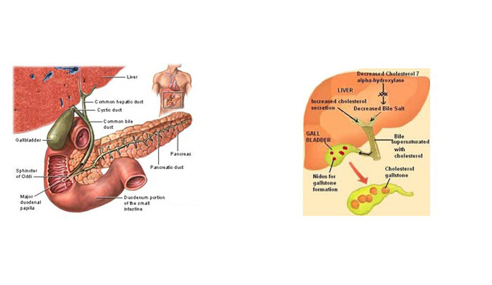 Gallstone Colic Treatment in Amroha
