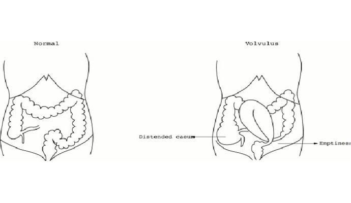 Gaseous Distension of The Abdomen Treatment in Gonda