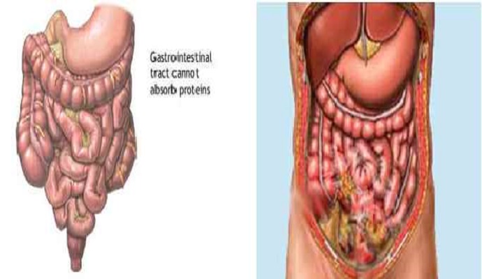 Gastrointestinal Perforation And Peritonitis