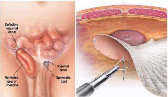 Hernia Surgeries