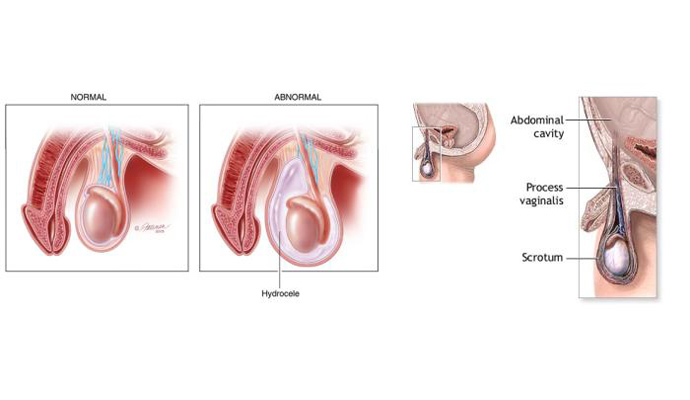 Hydrocoel Surgeries Treatment in Harautha