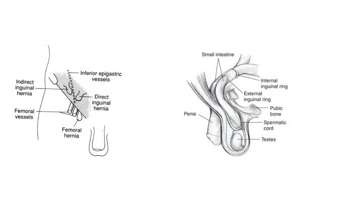 Indirect Inguinal Hernia Surgery Treatment in Atrauli