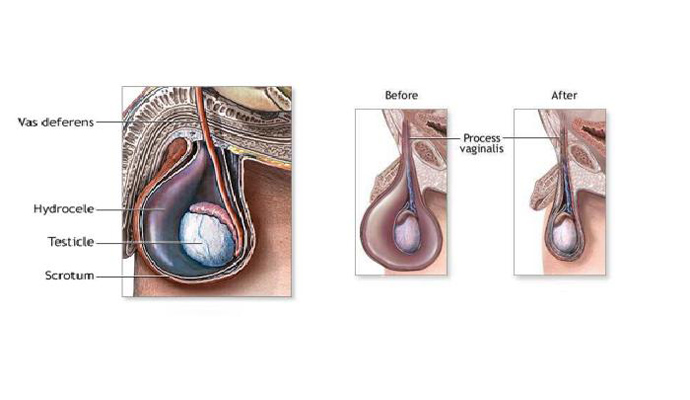 Infantile Hydrocele Treatment in Mathura