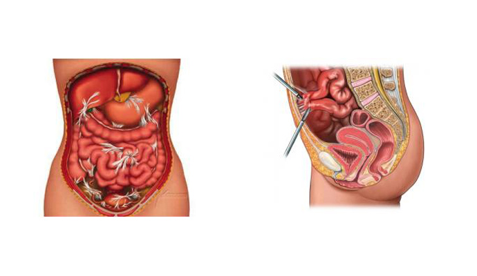 Intestinal Adhesions Tubercular Treatment in Harautha