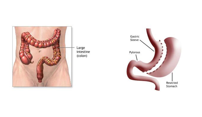 Intestines Bypass Operations