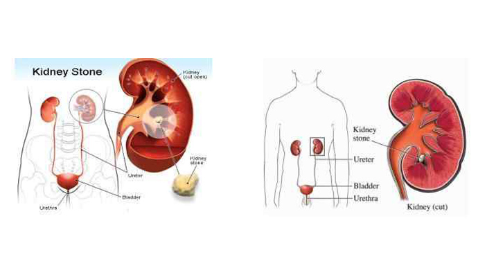 Kidney Stones Treatment in Shamli