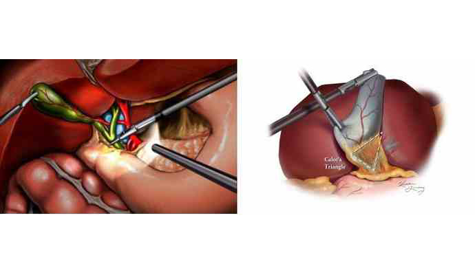 Laparoscopic cholecystectomy