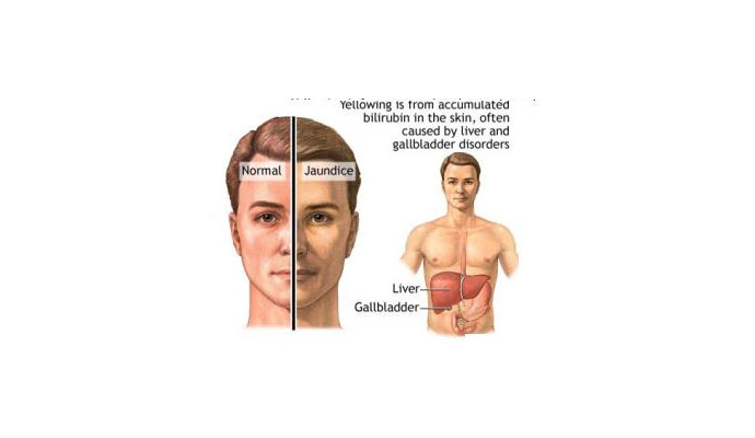 Medical Jaundice Treatment in Gonda