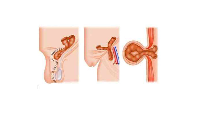 Obstructed Inguinal Hernia Treatment in Maharajganj