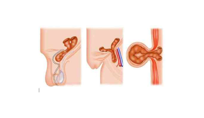 Obstructed Inguinal Hernia Treatment in Sant Ravidas Nagar