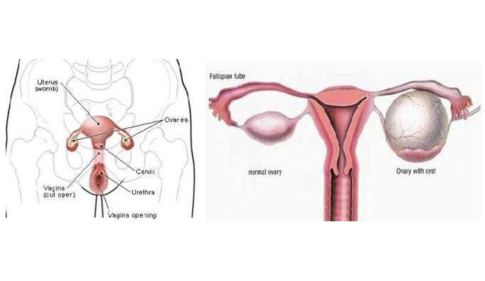 Ovarian Cyst Treatment in Shamli