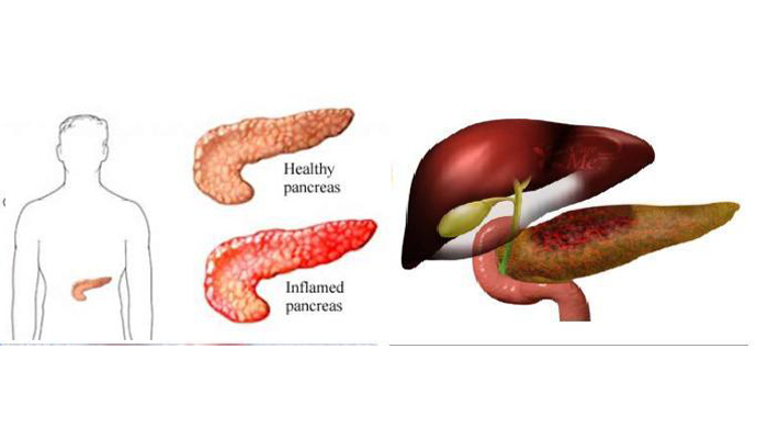 Pancreatitis Treatment in Jalalpur