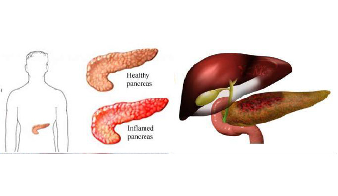 Pancreatitis Treatment in Ambedkar Nagar