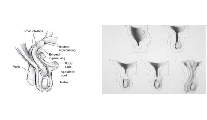 Pediatric Hernia Surgery Treatment in Gautam Buddha Nagar