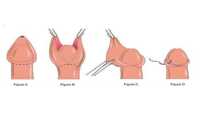 Phimosis Circumcision Treatment in Sambhal