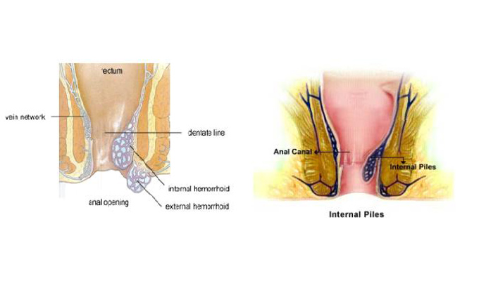 Piles Operations Treatment in Mau