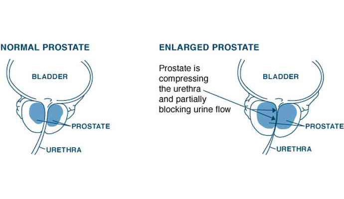 Prostate Gland Enlargement B P H Treatment in Banda