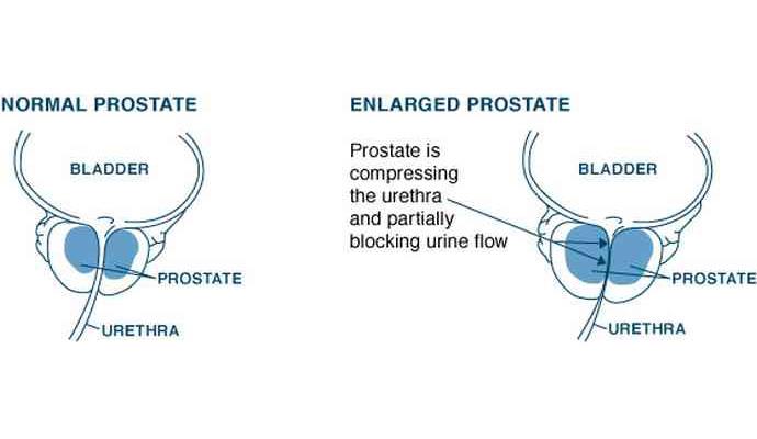 Prostate Gland Enlargement B P H Treatment in Bahadurpur Kota