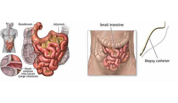 Small Bowel Perforations Treatment in Kaushambi