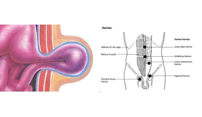 Strangulated Inguinal Hernia Treatment in Gonda